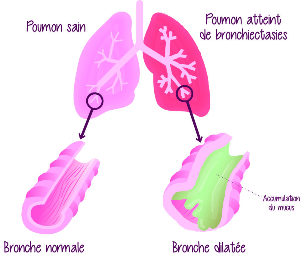 illustration dilatation des bronches